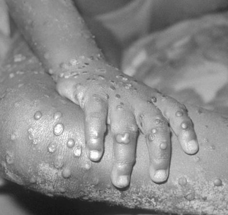 <span style='color:#780948'>ARCHIVED</span> - British tourist tested for monkeypox in Canary Islands