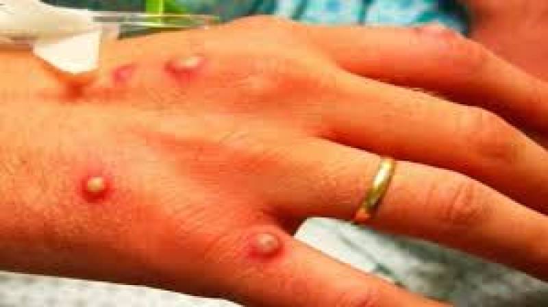 A dozen monkeypox cases now confirmed in the Valencia region
